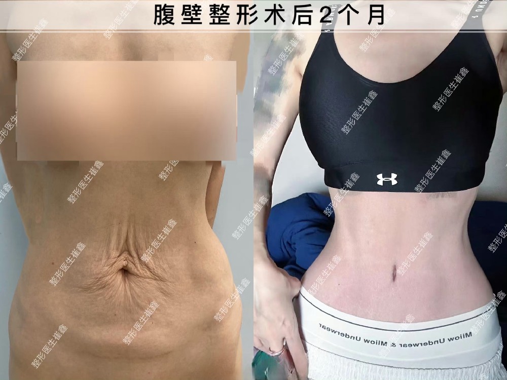 腹壁整形术后2个月