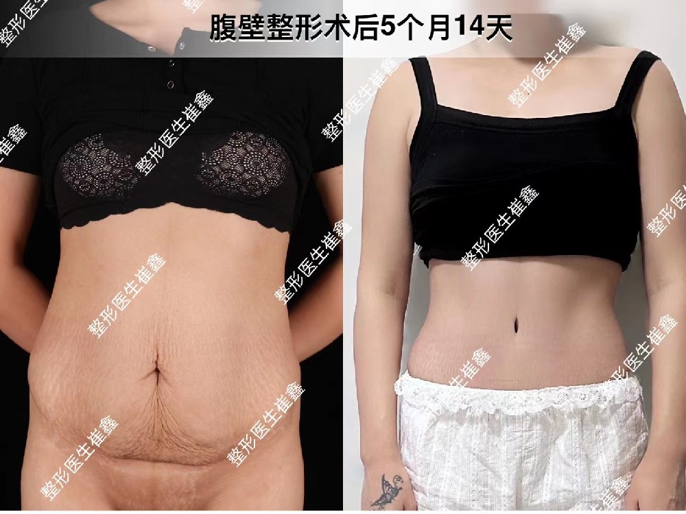 腹壁整形术后5个月14天