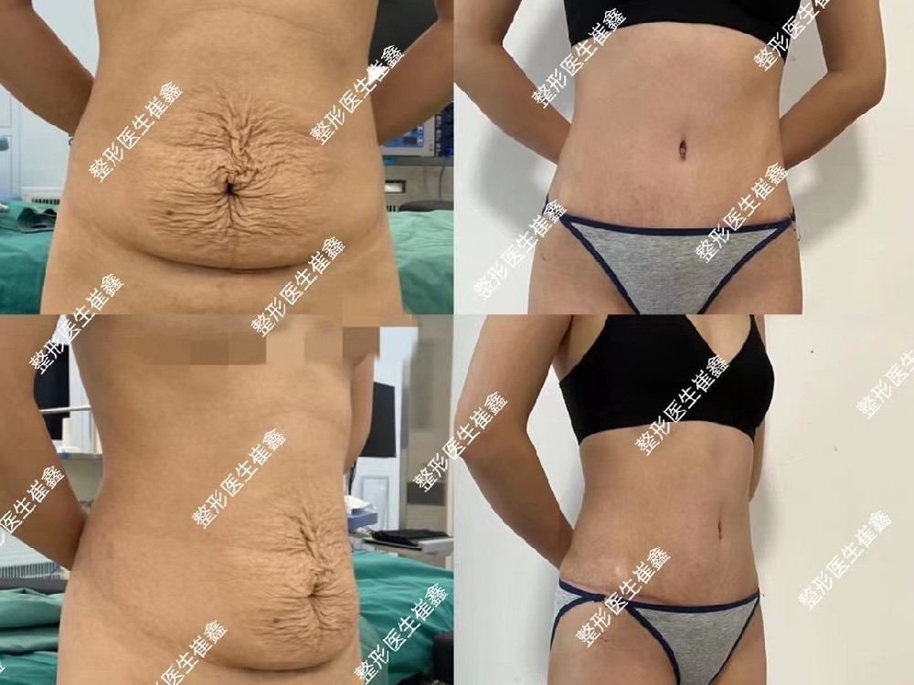 腹壁整形术后3个月