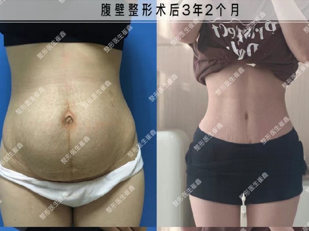 腹壁整形术后3年2个月