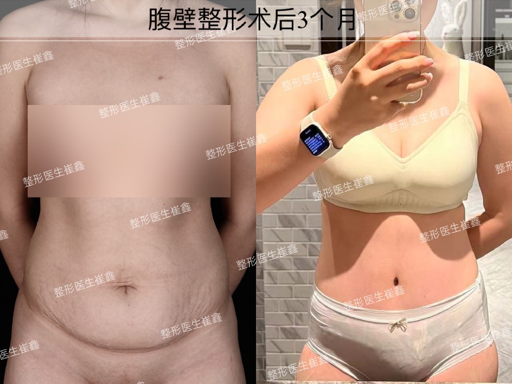 腹壁整形术后3个月