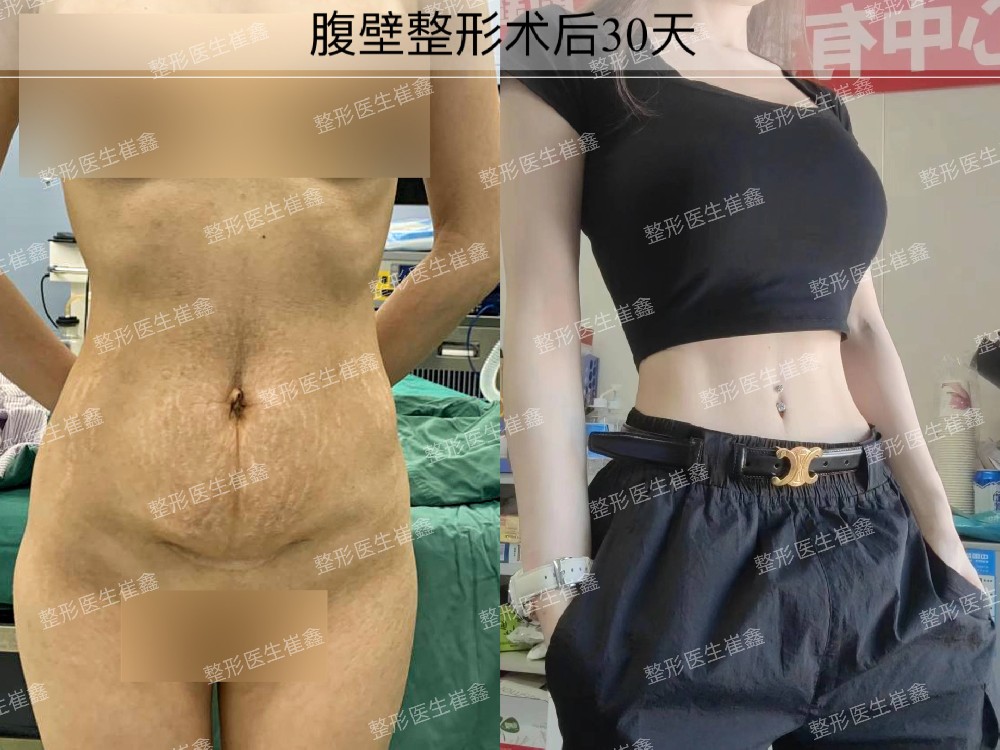 腹壁整形术后30天