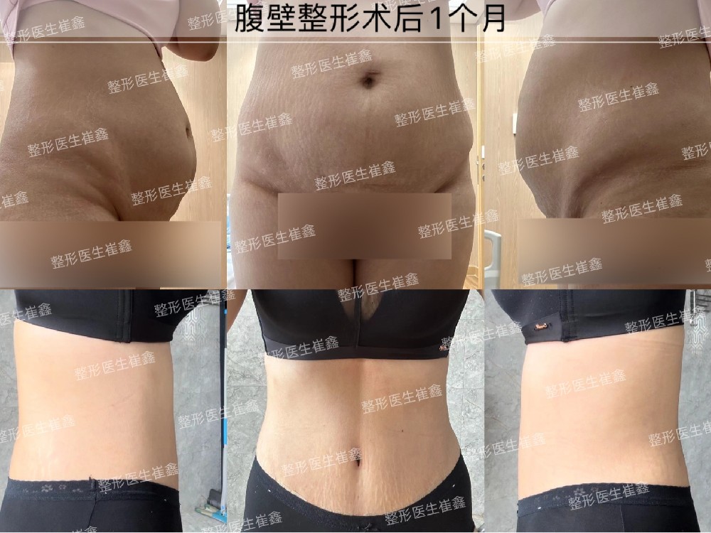 腹壁整形术后1个月