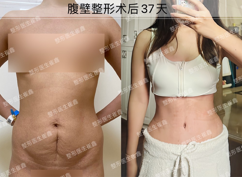 腹壁整形术后37天