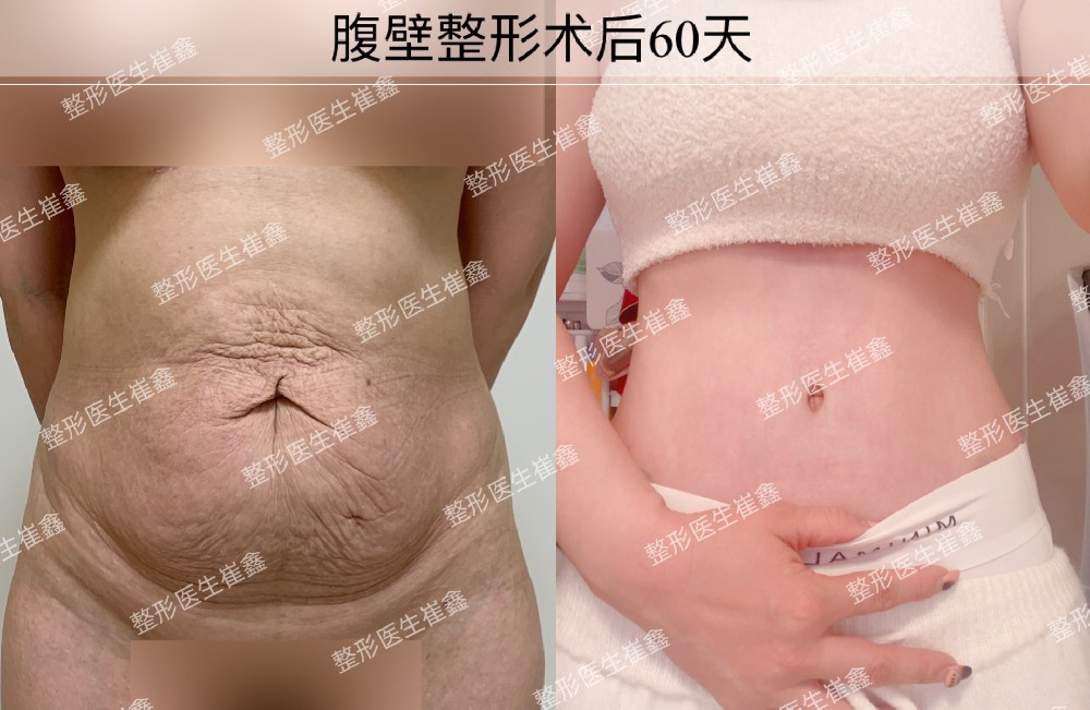 腹壁整形术后60天