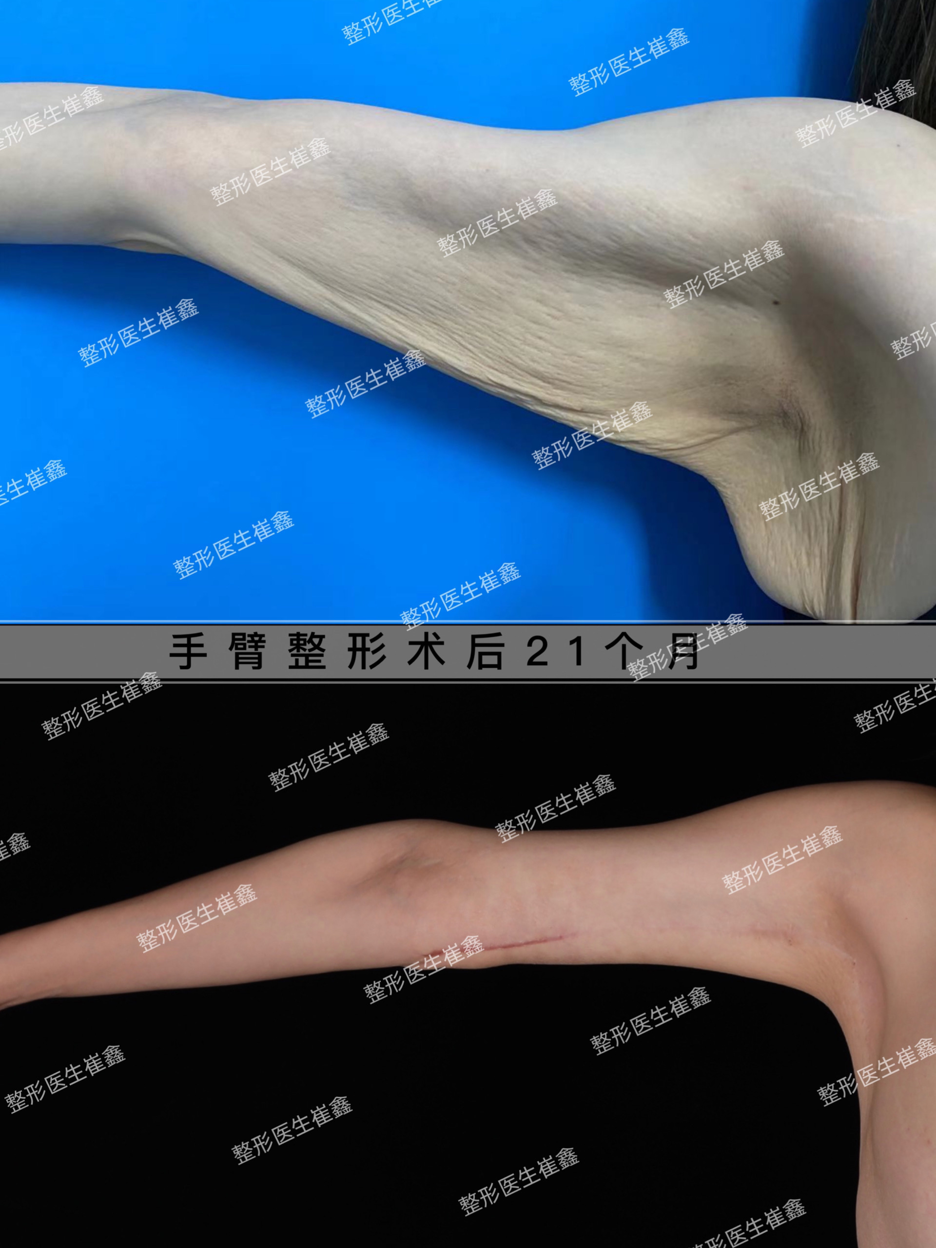 3.15手臂术后21个 月.jpg