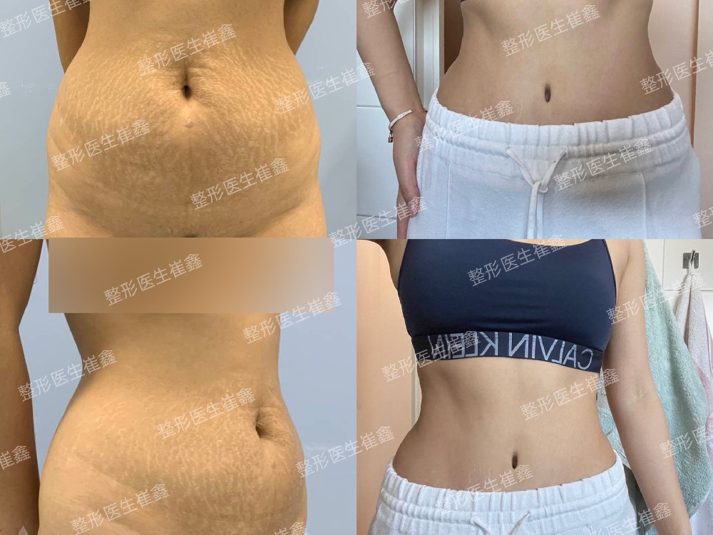 腹壁整形术后7个月