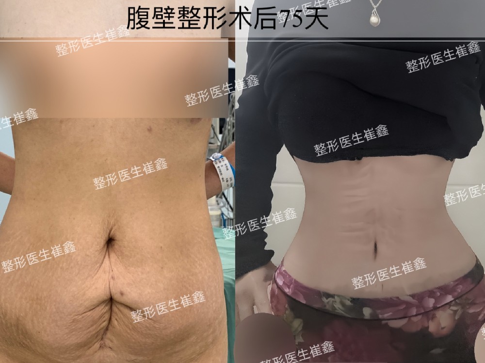 腹壁整形术后75天