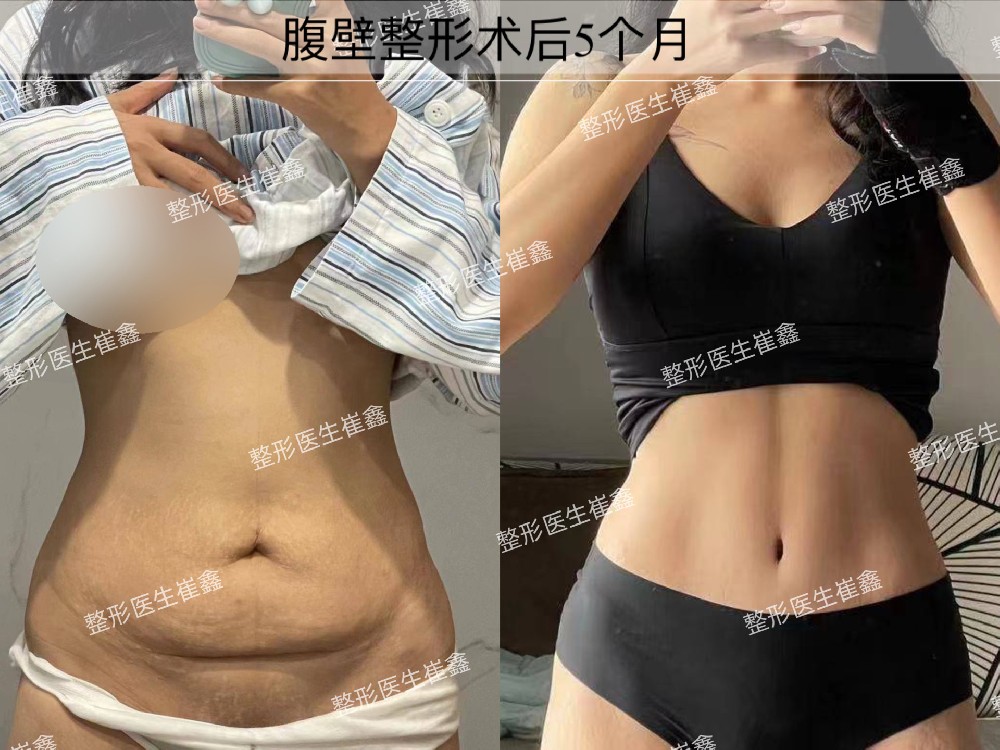 腹壁整形术后5个月