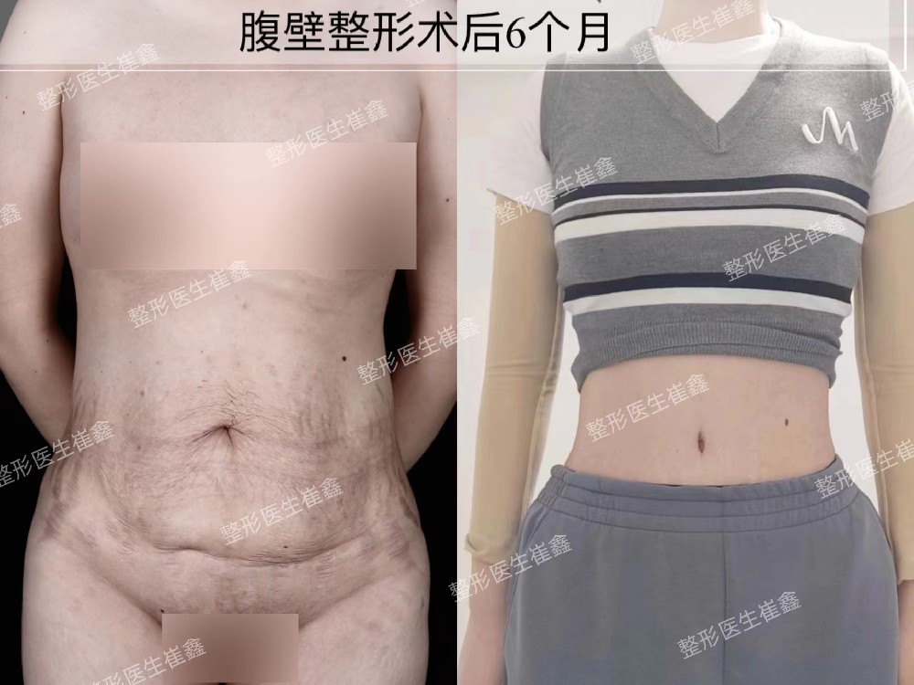 腹壁整形术后6个月