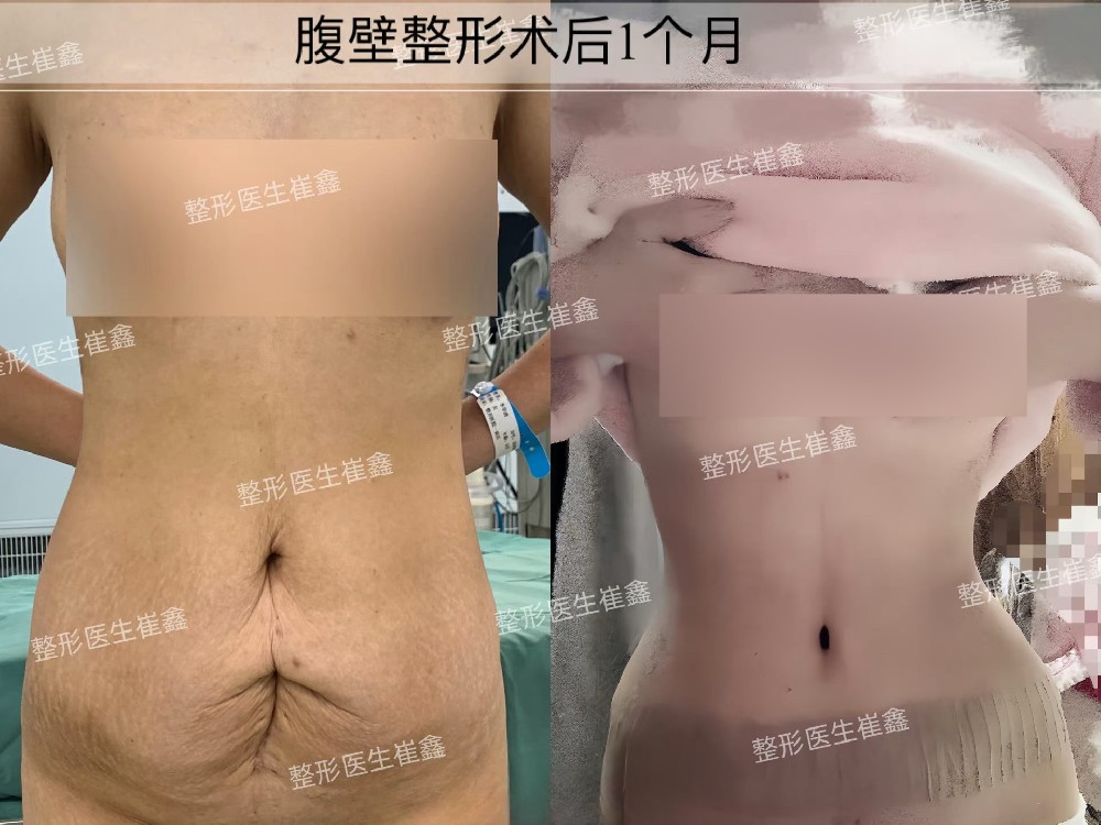 腹壁整形术后1个月