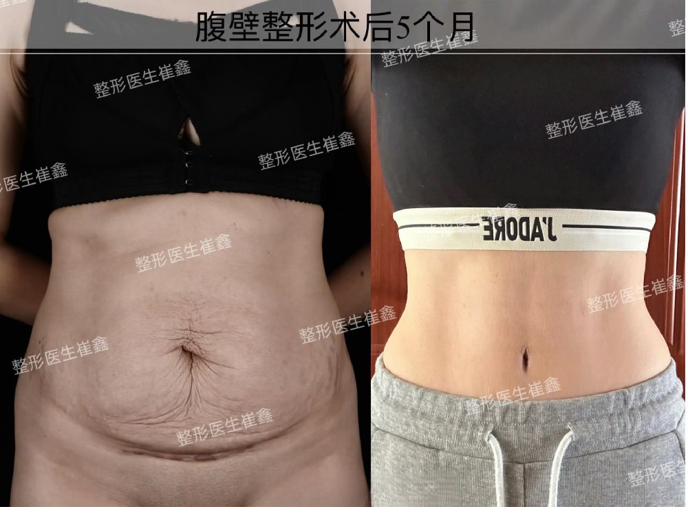 腹壁整形术后5个月
