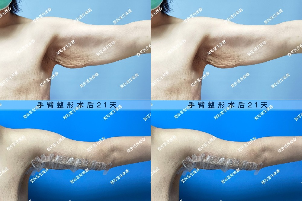 手臂整形术后21天
