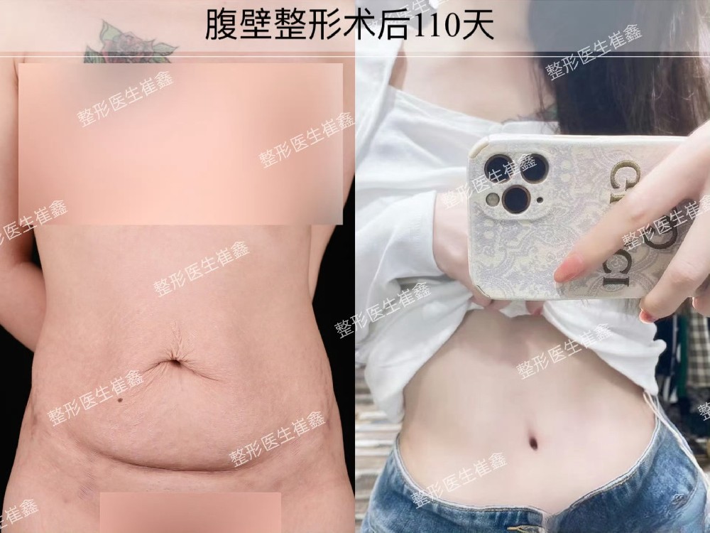 腹壁整形术后110天