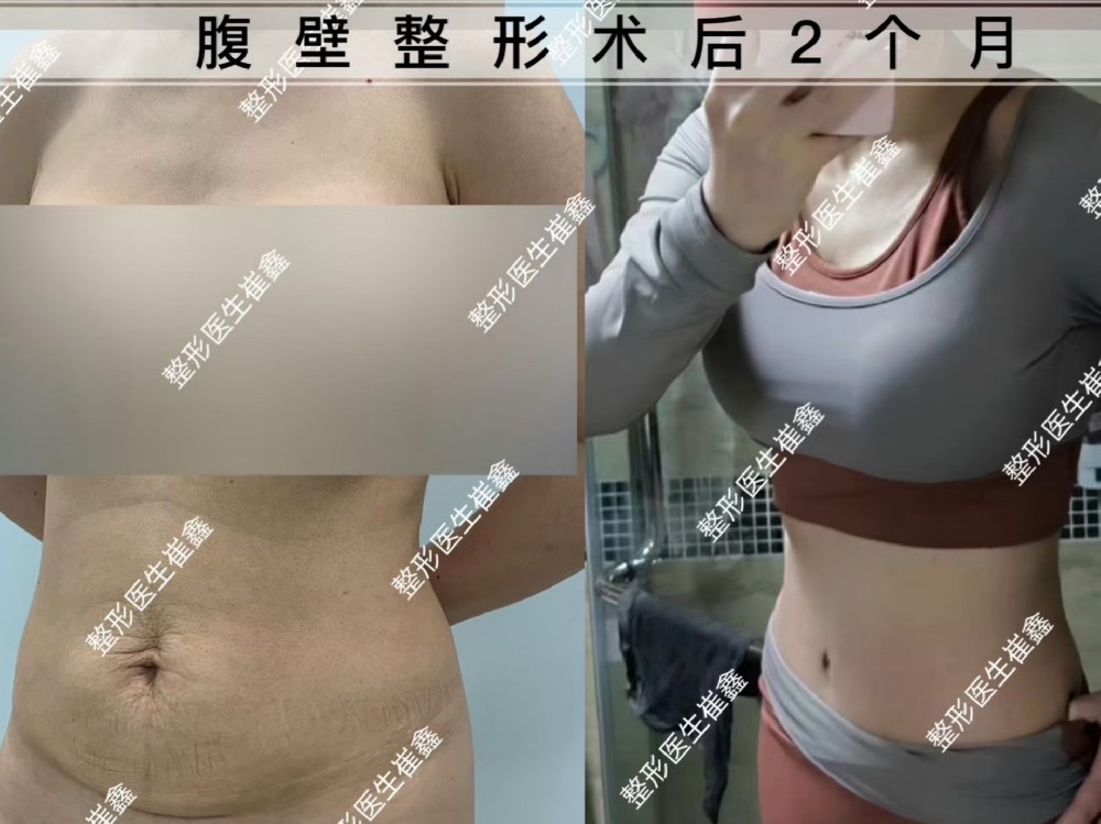 腹壁整形术后2个月