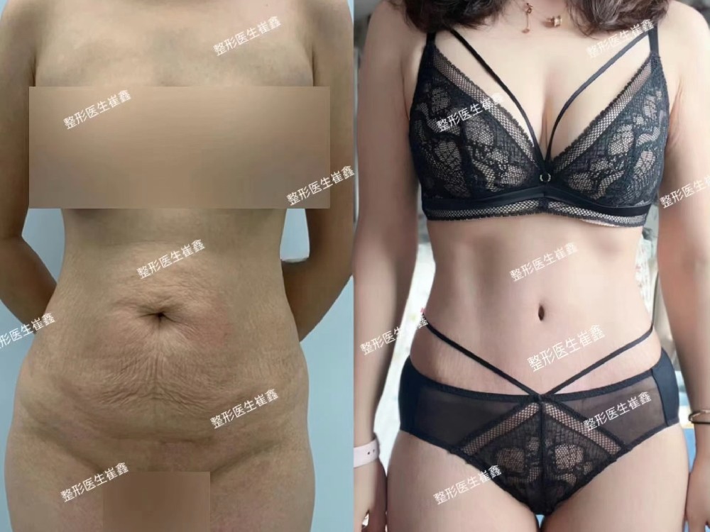 腹壁整形术后42天