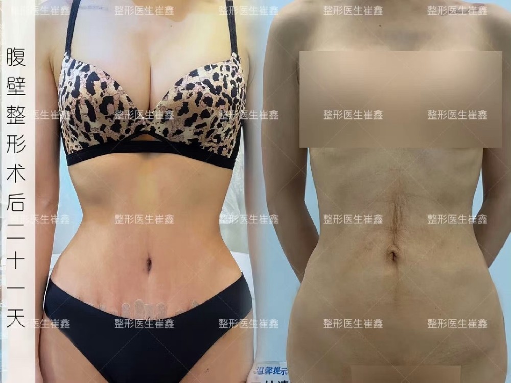 腹壁整形术后21天