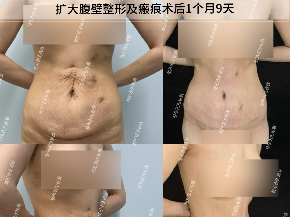 扩大腹壁整形术后1个月9天