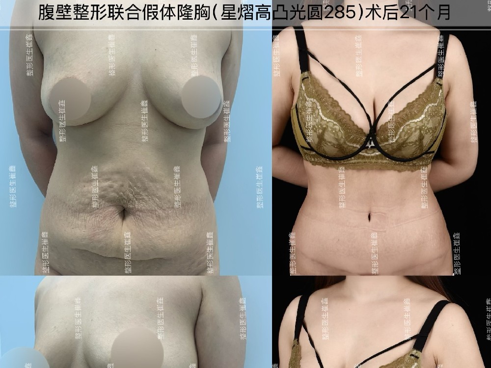 腹壁整形联合假体隆胸（星熠高凸光圆285）术后21个月