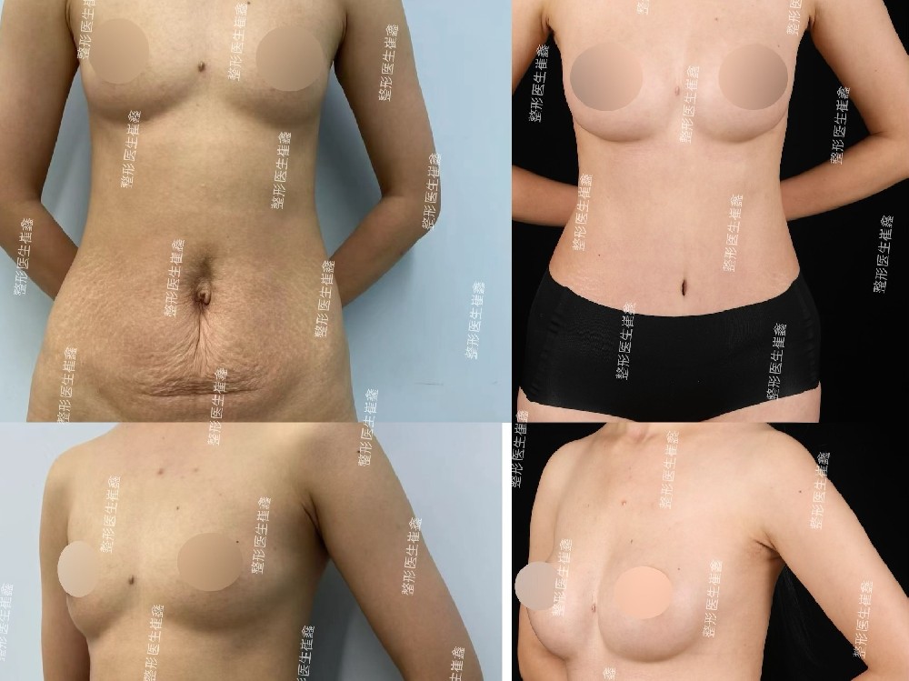 腹壁整形联合假体隆胸（Motiva Demi 265）术后7个月10天