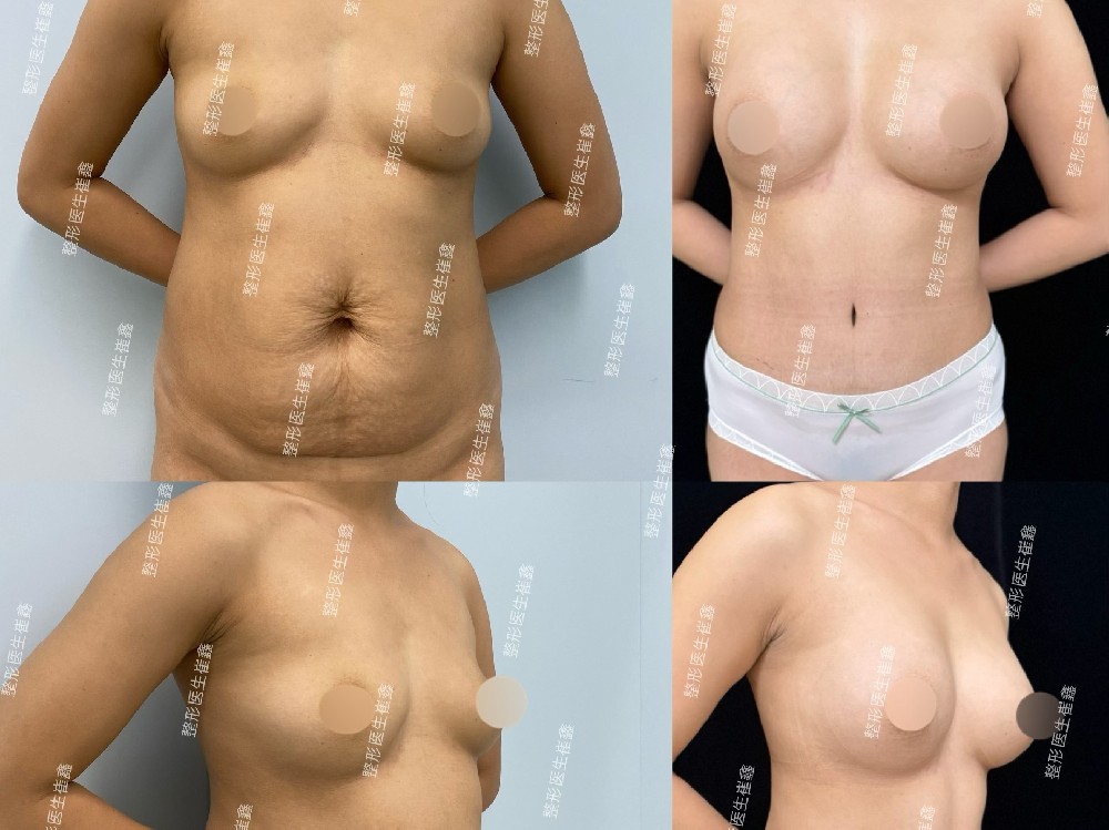 腹壁整形联合假体隆胸（曼托光圆中凸250）术后5个月