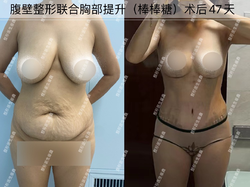 腹壁整形联合胸部提升（棒棒糖）术后47天