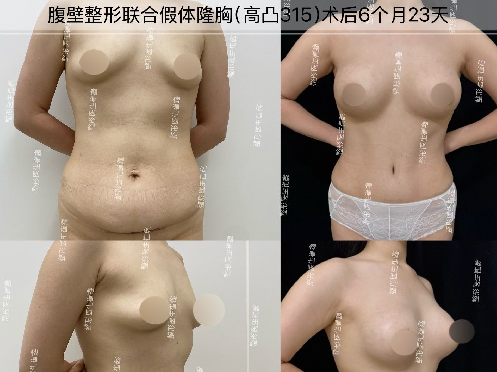 腹壁整形联合假体隆胸(高凸315)术后6个月23天
