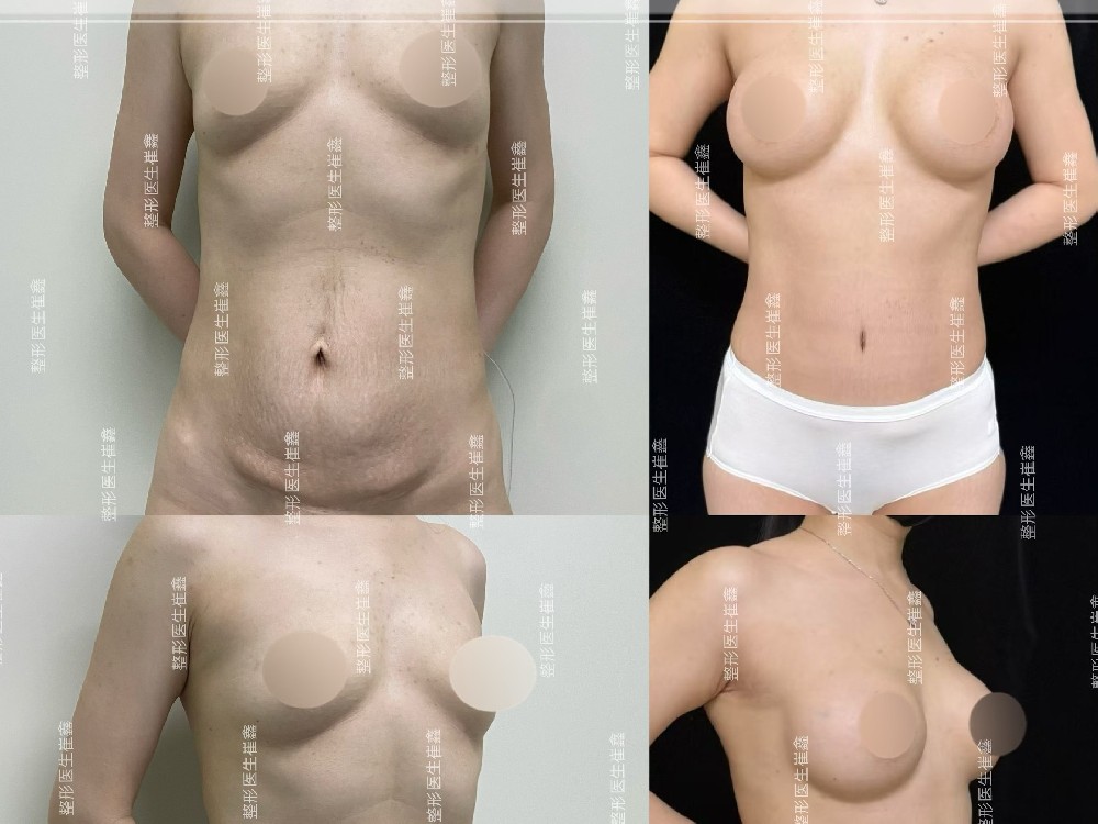 腹壁整形联合假体隆胸(Motiva Demi265)术后7个月10天