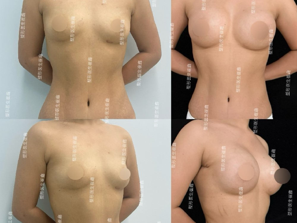 假体隆胸(曼托光圆中凸300)术后6个月