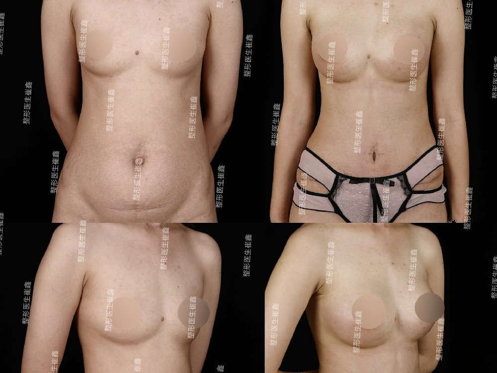 腹壁整形联合假体隆胸(星熠高凸285)术后1个月17天