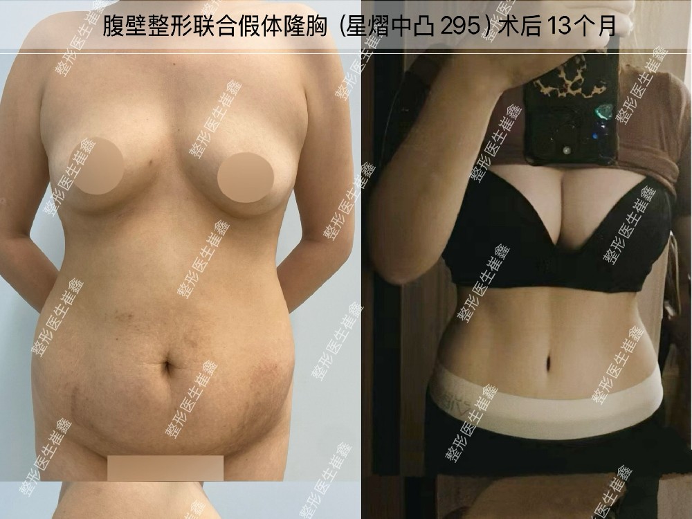 腹壁整形联合假体隆胸(星熠中凸 295)术后13个月