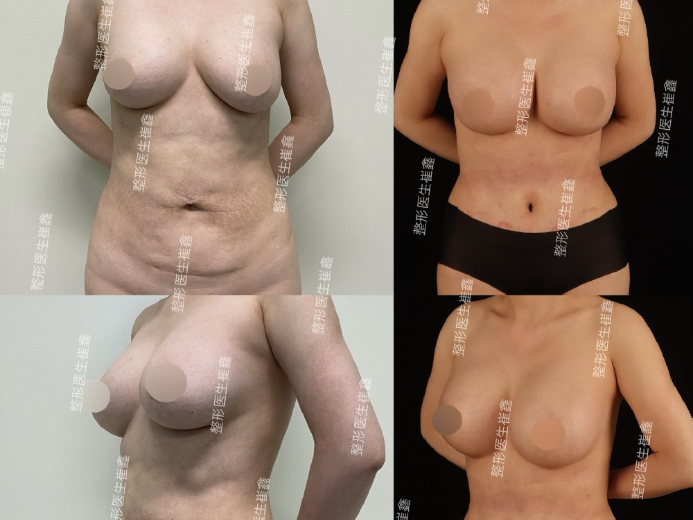 腹壁整形联合假体隆胸（Motiva中凸265）术后一个月21天