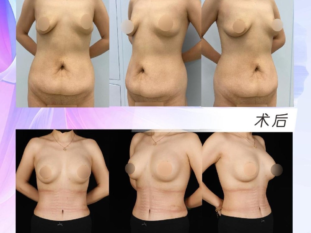 腹壁整形联合假体隆胸(星熠中昌270)术后2个月26天