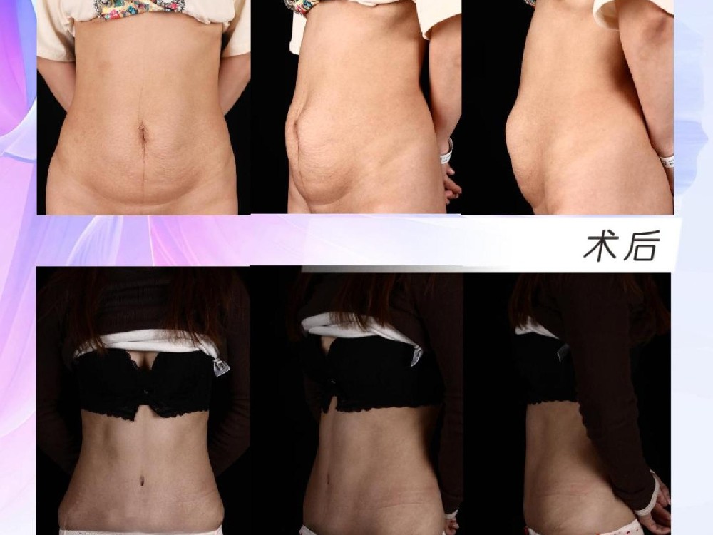 腹壁整形术后1年5个月