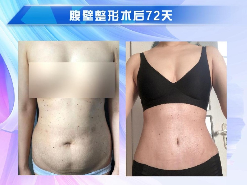 腹壁整形术后72天