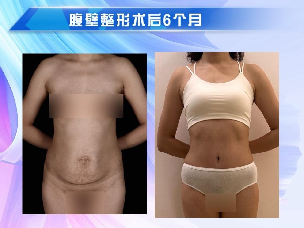 腹壁整形术后6个月