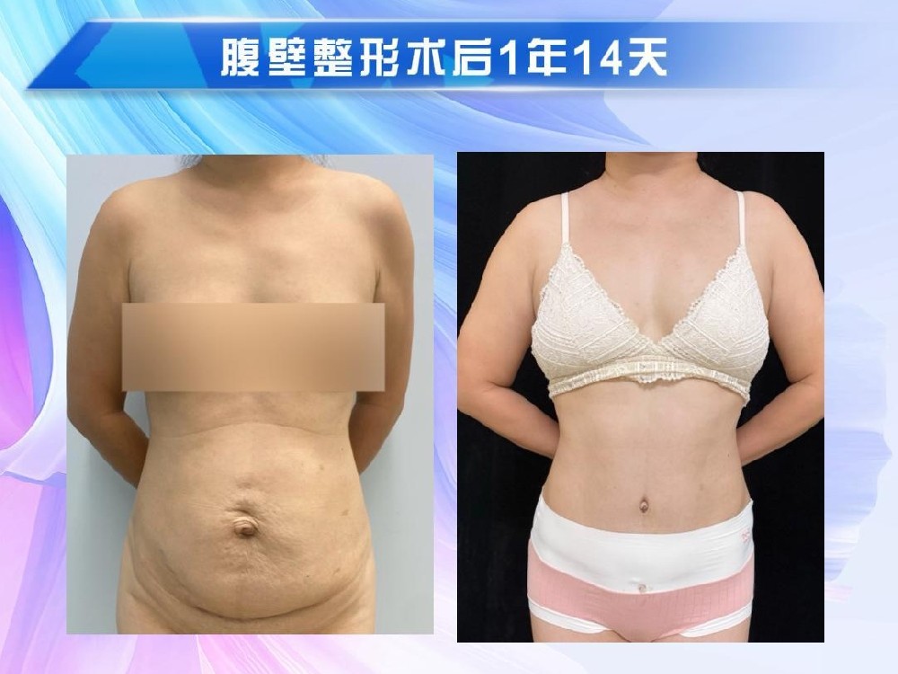 腹壁整形术后1年14天
