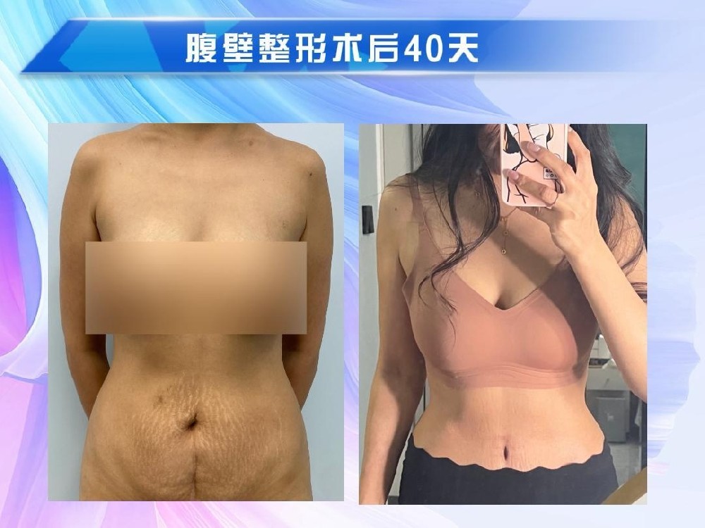 腹壁整形术后40天