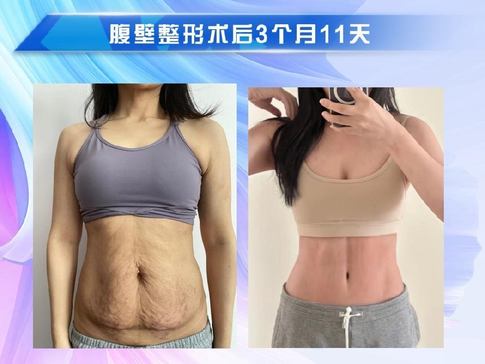 腹壁整形术后3个月11天