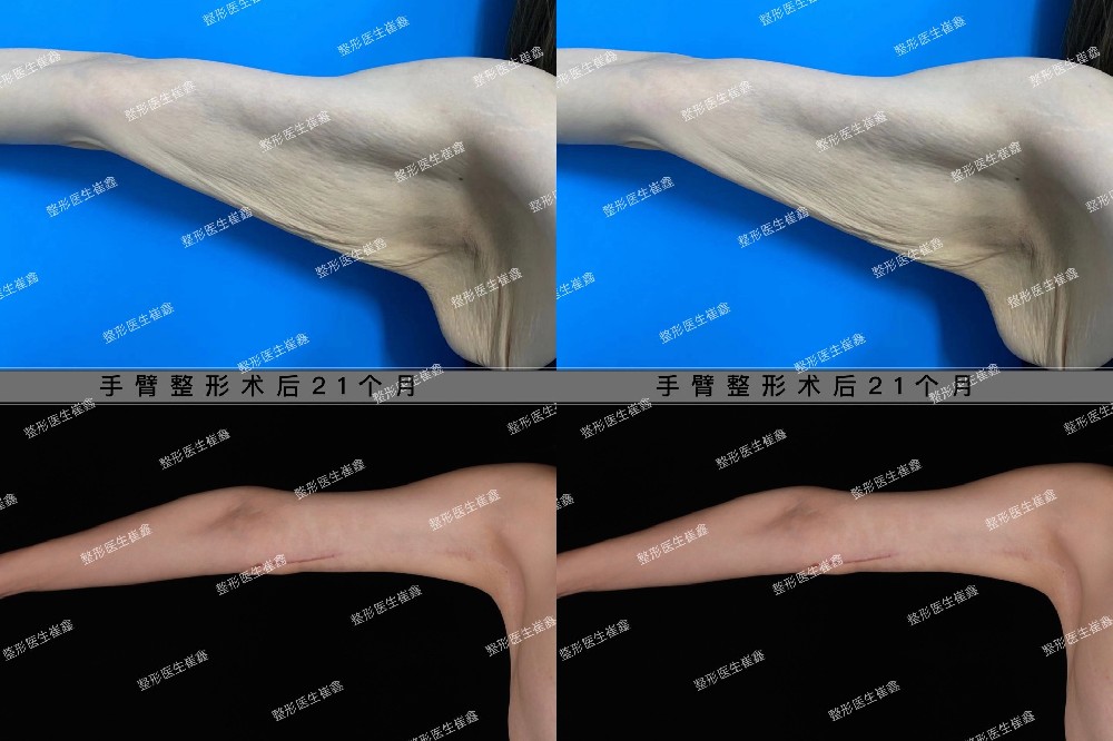 手臂整形术后21个月