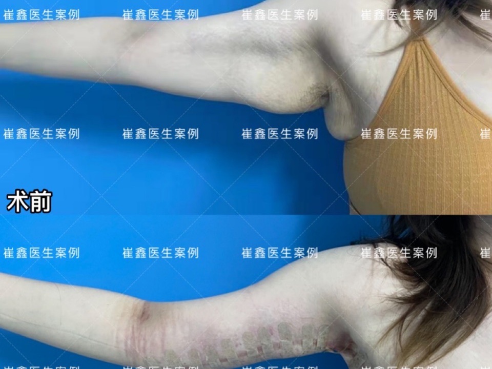 手臂整形术后21天