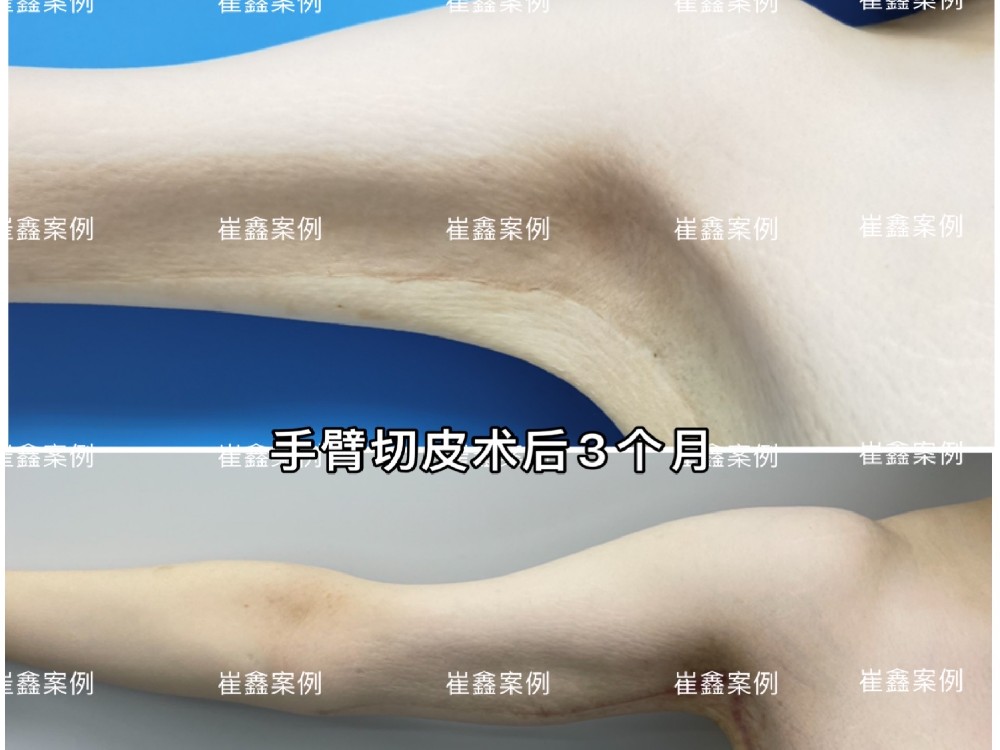 手臂切除术后3个月