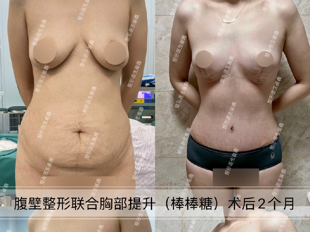 腹壁整形联合胸部提升(棒棒糖)术后2个月