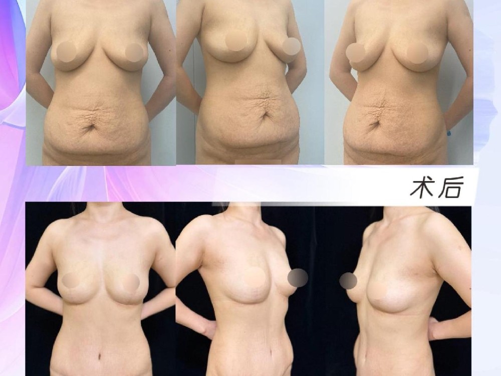 腹壁整形联合胸部提升术后9个月20天
