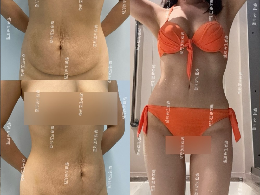 腹壁整形术后9个月21天