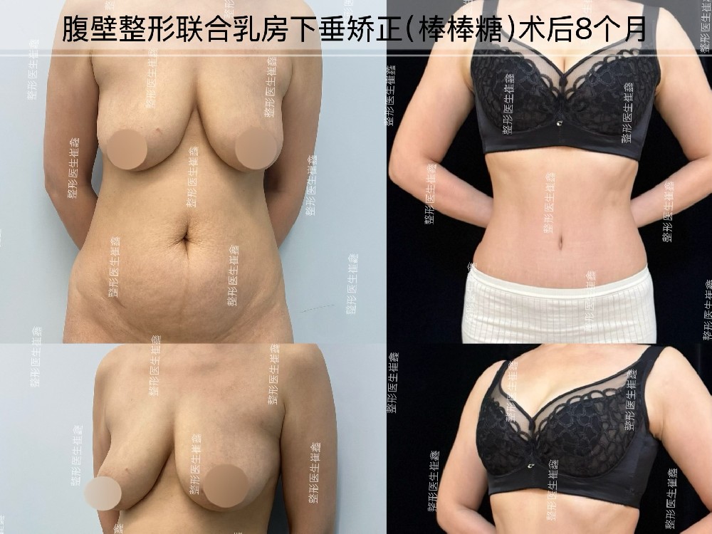 腹壁整形联合乳房下垂矫正术后8个月