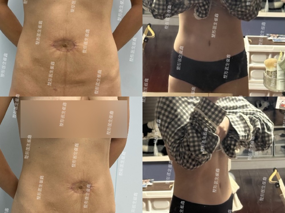 腹壁整形修复术后17个月