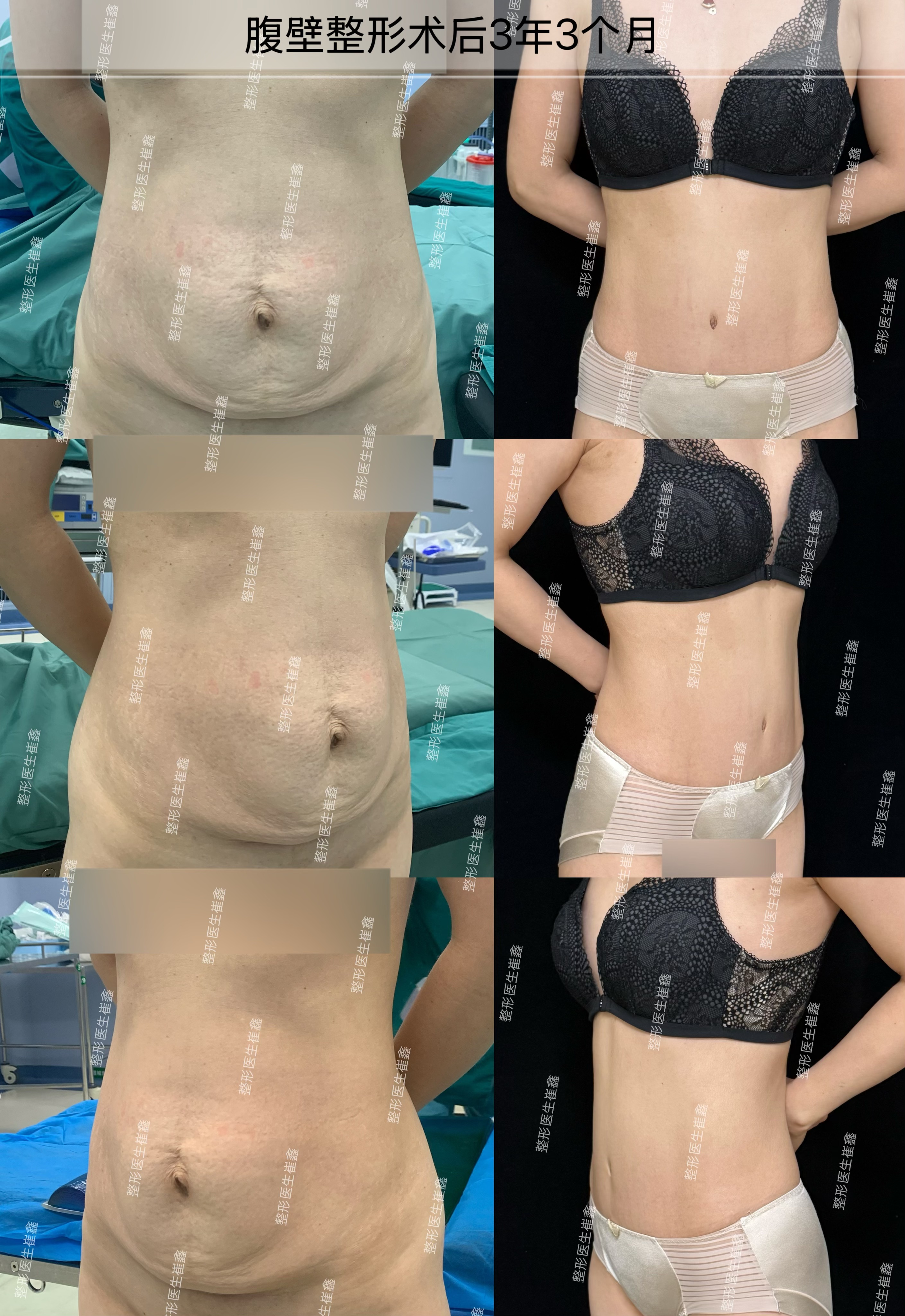 腹壁.jpeg