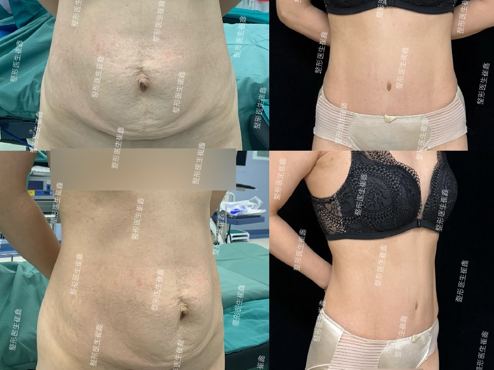 腹壁整形术后3年3个月