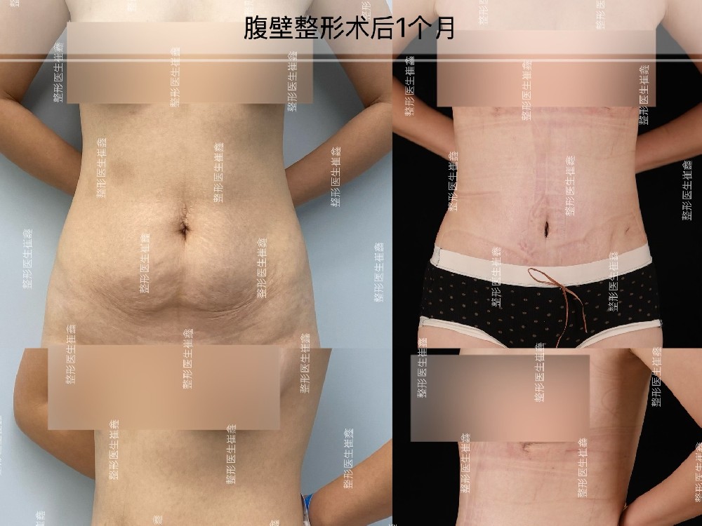腹壁整形术后1个月